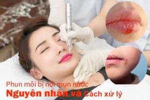 Phun môi bị nổi mụn nước - Nguyên nhân và cách xử lý